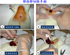 部份肝切除手術