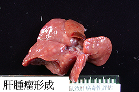 肝表面腫瘤結節形成
